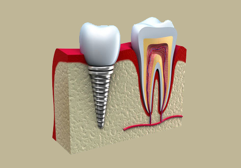 Противопоказания к имплантации зубов
